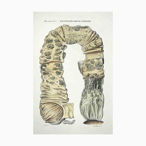 Ottavio Muzzi, Diseases of the Large Intestine, Lithograph, 1843