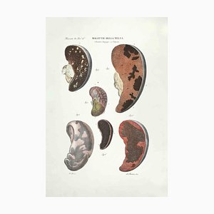 Ottavio Muzzi, Spleen Diseases, Lithograph, 1843