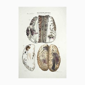Ottavio Muzzi, Brain Diseases, Lithograph, 1843
