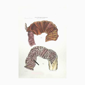 Ottavio Muzzi, Erkrankungen des Darms, Lithographie, 1843