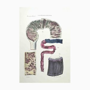 Ottavio Muzzi, Diseases of the Intestines, Lithograph, 1843