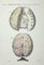 Ottavio Muzzi, Brain Diseases, Lithograph, 1843 1