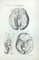 Ottavio Muzzi, Maladies du Cerveau, Lithographie, 1843 1